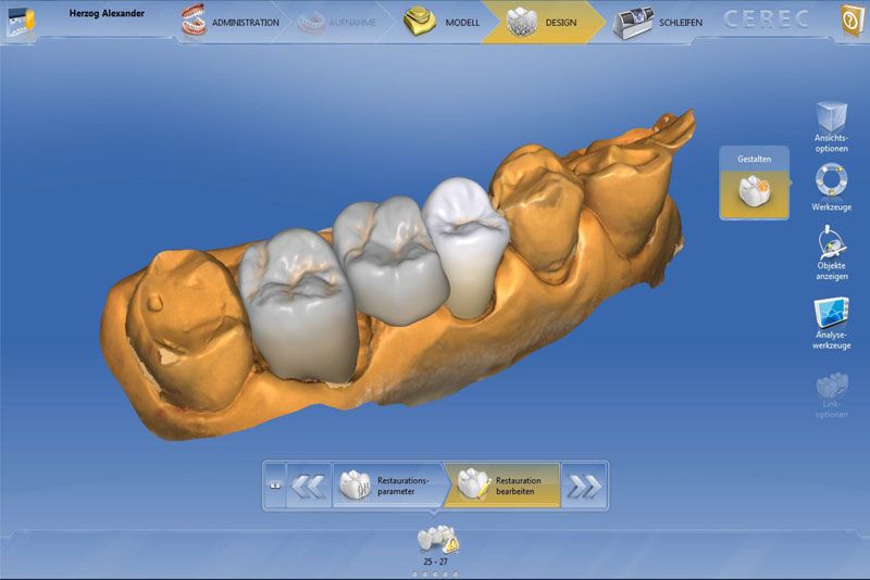 Instant Dental Bridge Dentist Vienna