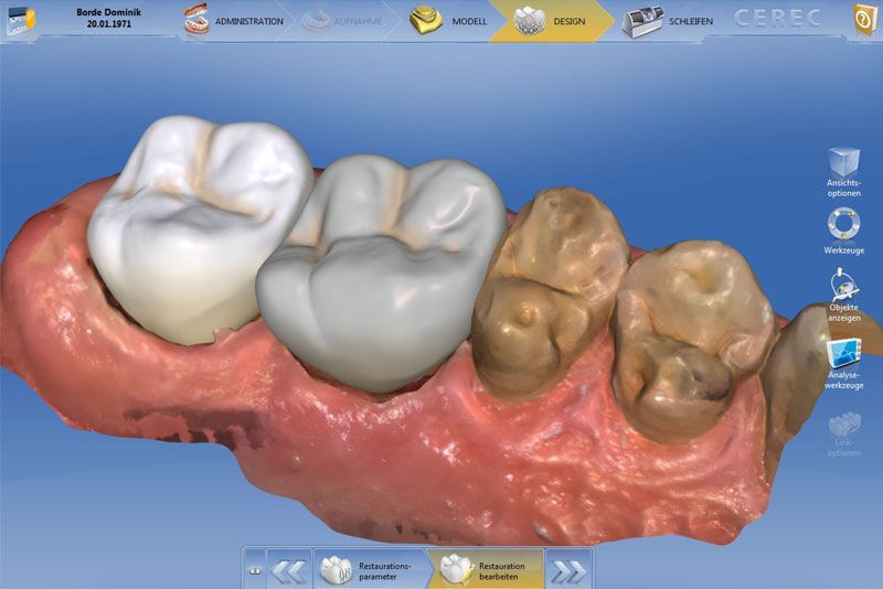 CEREC Sofortbrücke Zahnarzt Wien