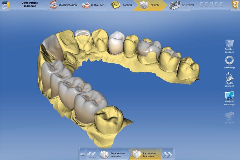 Instant Dental Bridge Dentist Vienna