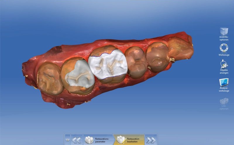 CEREC Sofortinlay Zahnarzt Wien