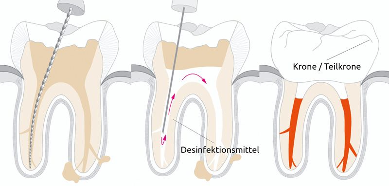 Skizze einer Wurzelbehandlung