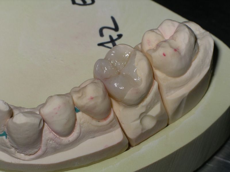 Ceramic Inlays Dentist Vienna