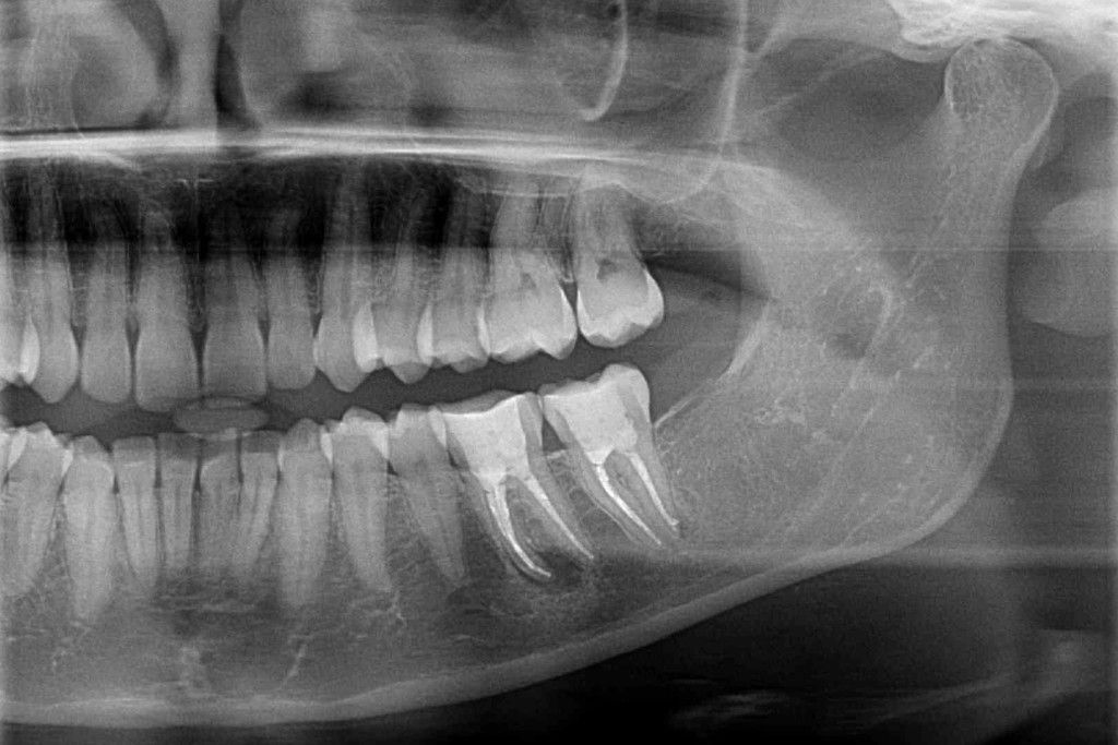 Röntgenaufnahme von Zysten im Mundbereich