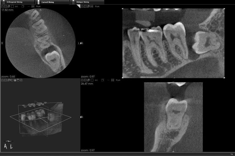 Zahnfleisch weisheitszahn drückt gegen Druckschmerz Zähne